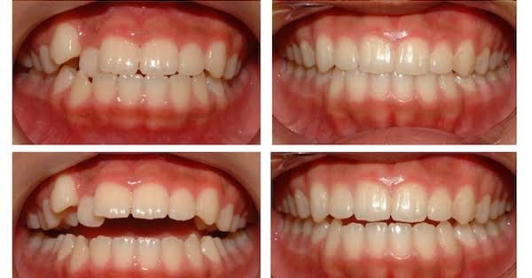 Pre & Post Surgery Photos of Teeth Alignment & Smile Designing