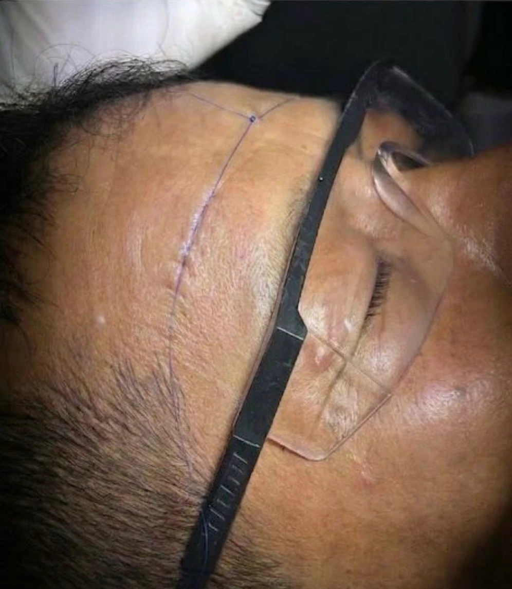 Post Image of Cyst Removal Surgery