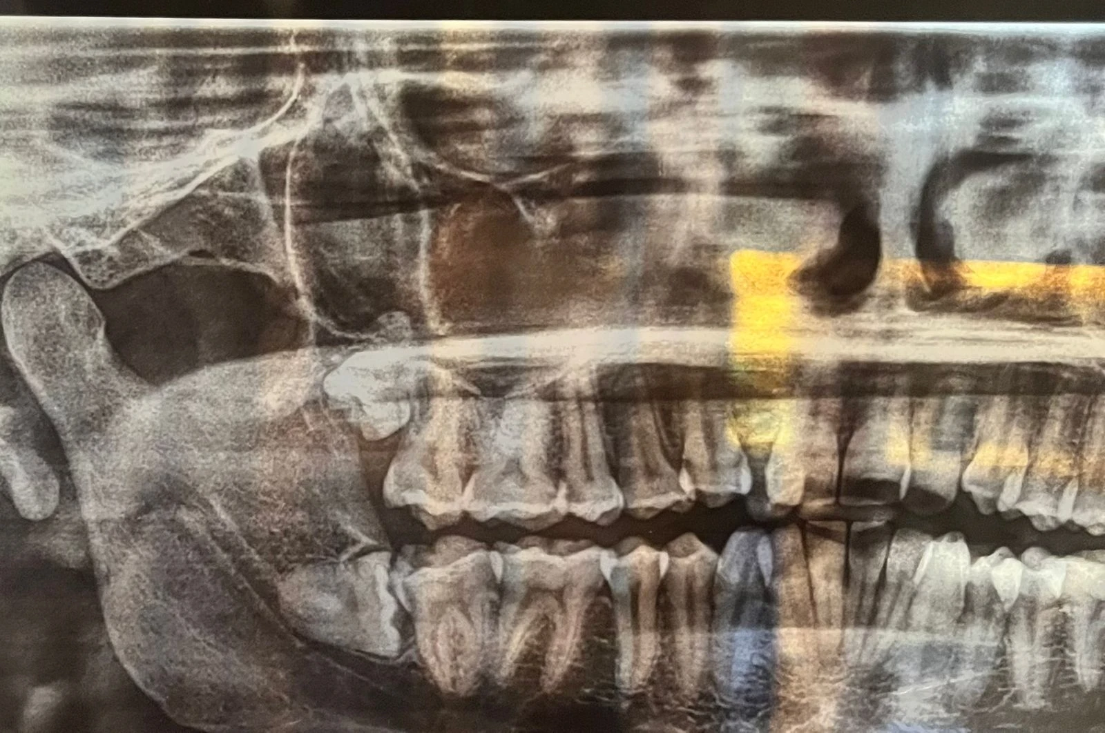 X-Ray Image of Teeth Before Wisdom Tooth Extraction