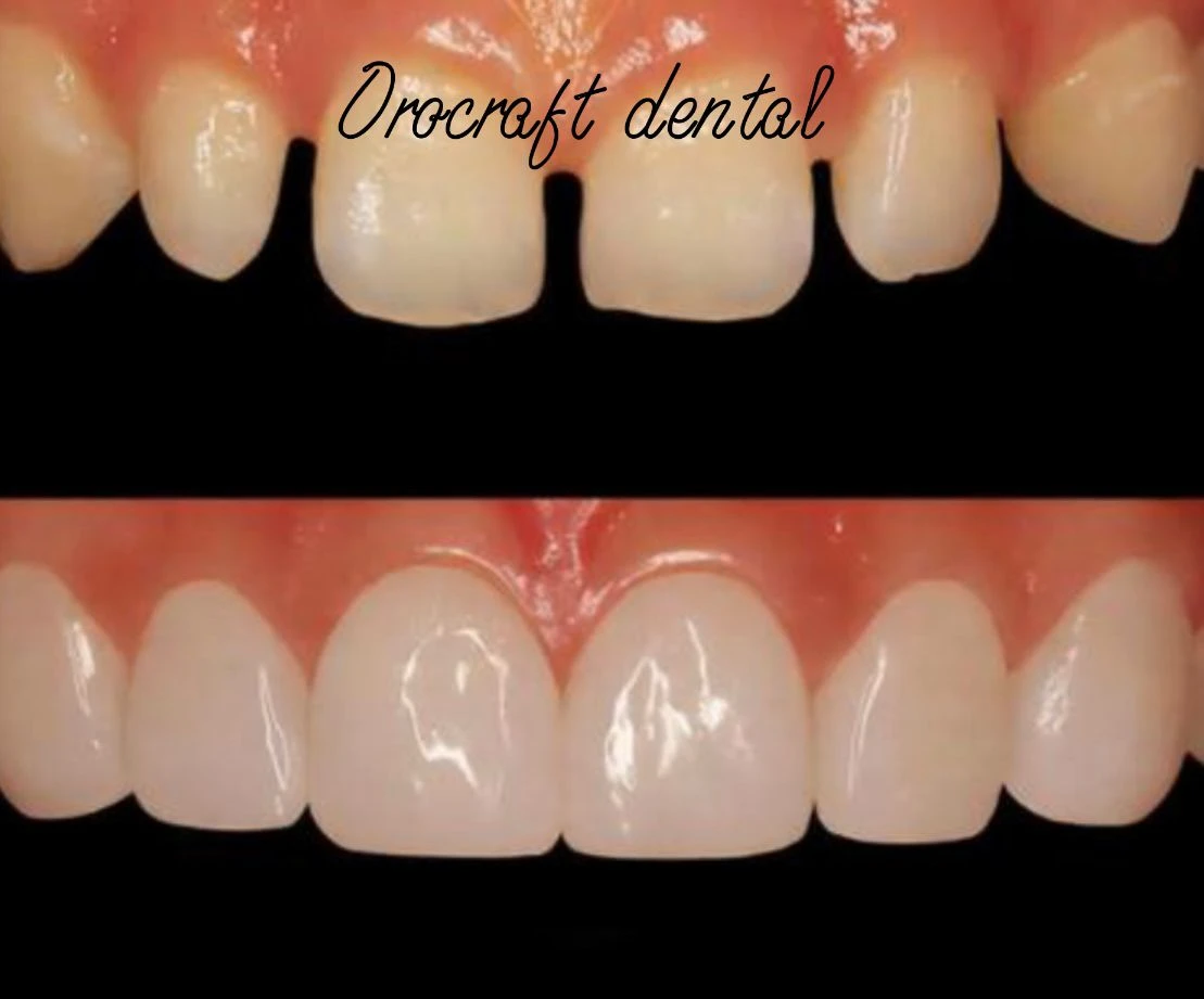 Pre & Post Surgery Photos of Teeth Alignment