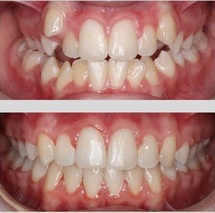 Pre & Post Surgery Photos of Smile Designing