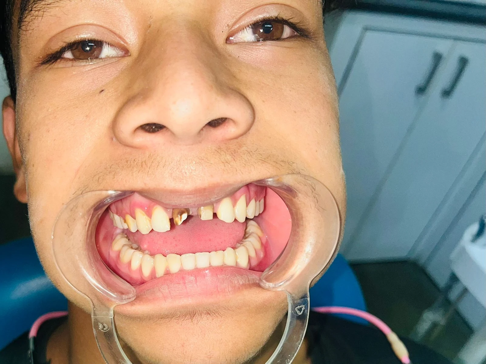 Pre Image of Restorative Dentistry Procedure