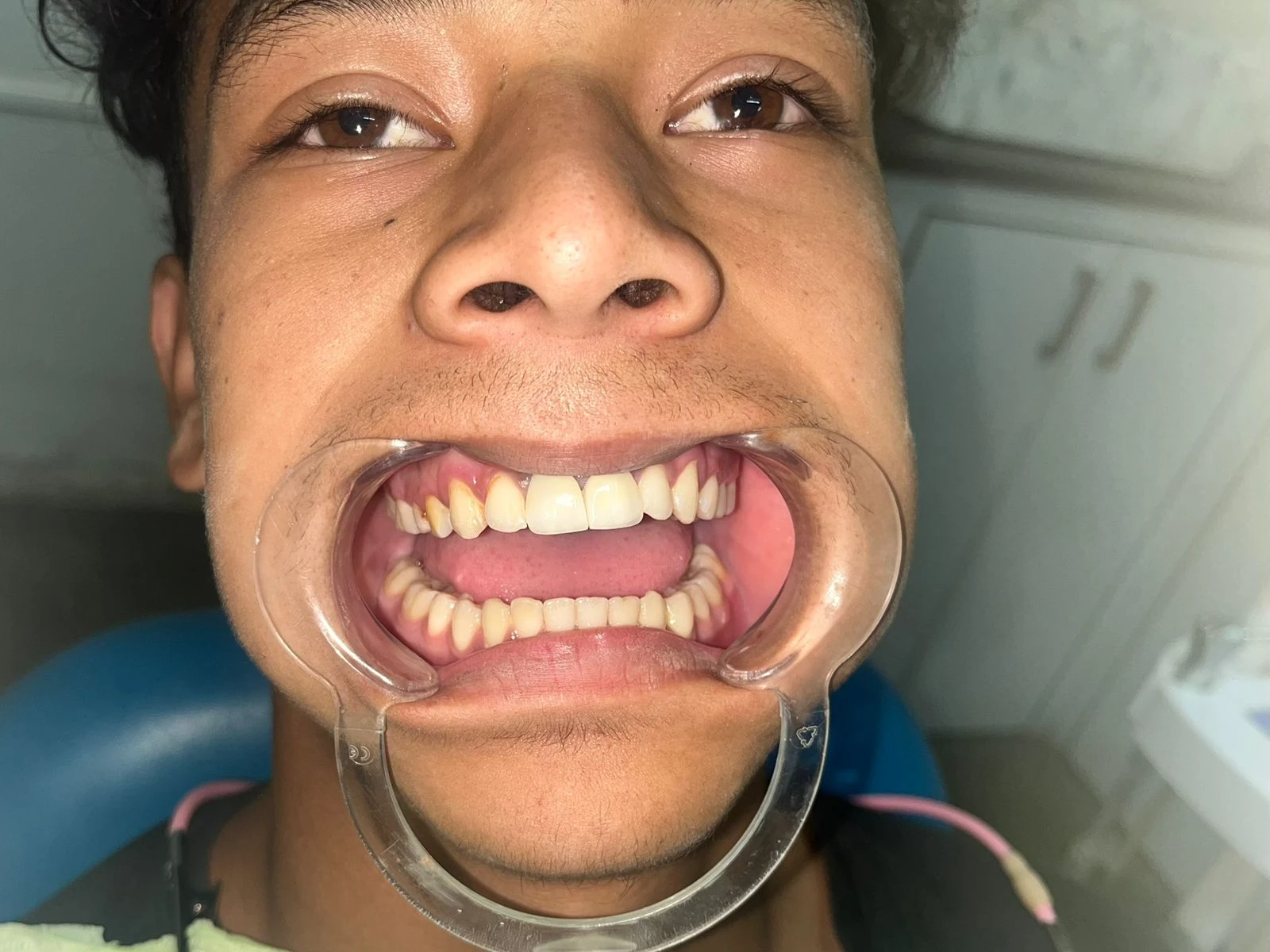 Post Image of Restorative Dentistry Procedure