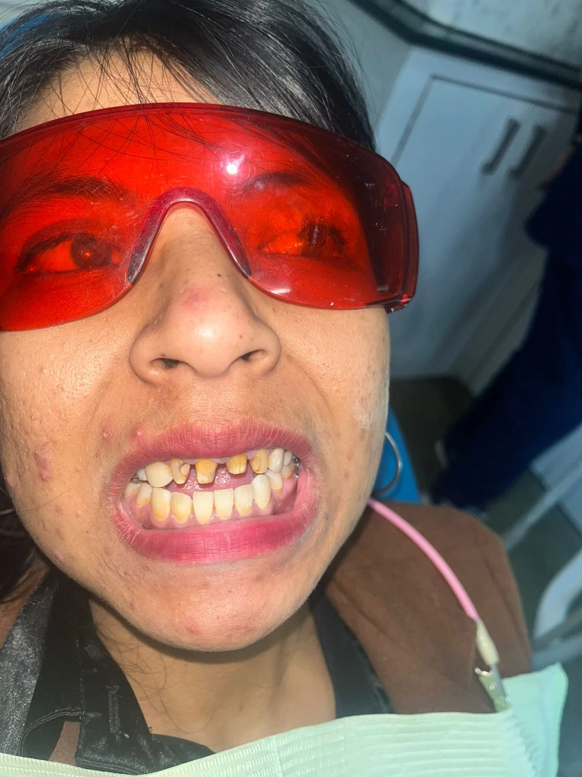 Pre Image of Teeth Alignment Surgery