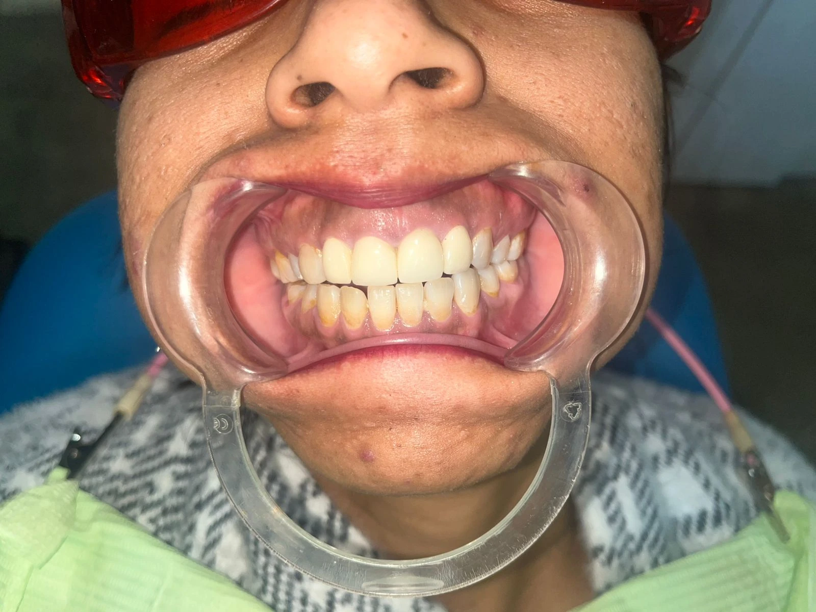 Post Image of Teeth Alignment Surgery