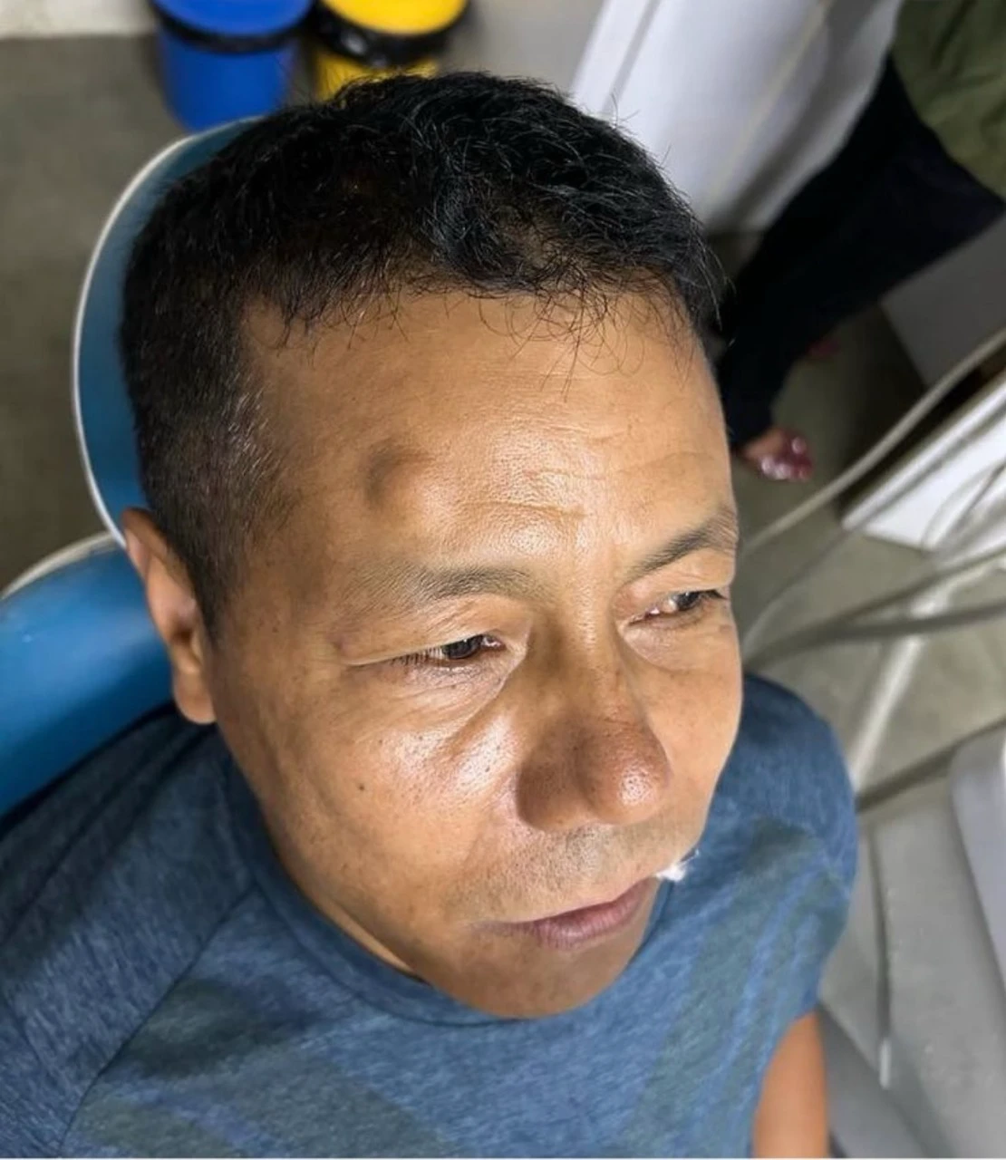 Pre Image of Cyst Removal Surgery